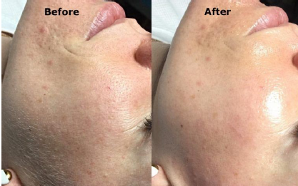 Tris Alves Makeup Dermaplaning Before and After 2